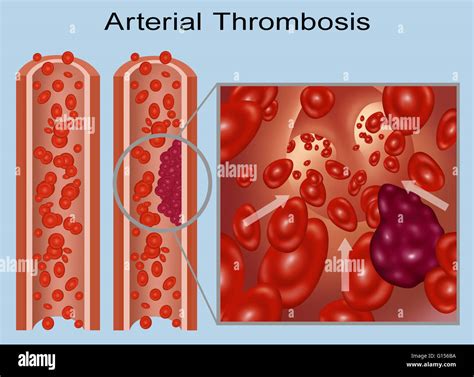 Trombosis En Arteria Coronaria Fotografías E Imágenes De Alta