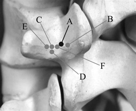 The Optimal Point Of Pedicle Screw Entry Is At The Junction Of The Pars Download Scientific