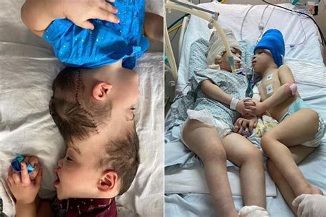 Brazil के डॉक्टरों ने सर्जरी में ली वर्चुअल रियलटी की मदद सिर से जुड़े जुड़वा बच्चों को किया