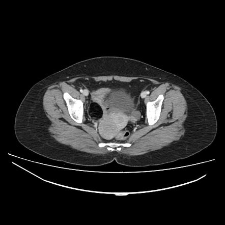 Ovarian Dermoid Cyst Radiology Case Radiopaedia Org