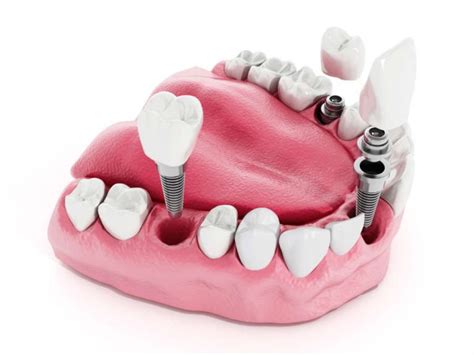 How Many Teeth Can One Implant Support Why You Need To Know