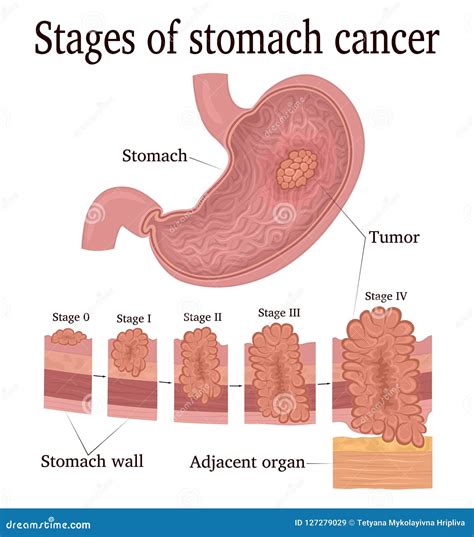 Stages Of Stomach Cancer Stock Vector Illustration Of Gastric 127279029