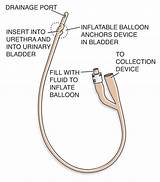 Photos of Foley Catheter Equipment