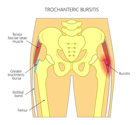 Trochanteric Bursitis A Helpful Introduction Overview Dr Andrachuk