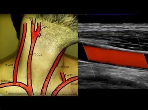 Carotid Duplex Exam YouTube Ultrasound Sonography Vascular