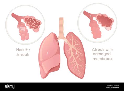 Human Lungs Alveoli With Damaged Membrane Cartoon Design Human Anatomy Organ Vector Illustration