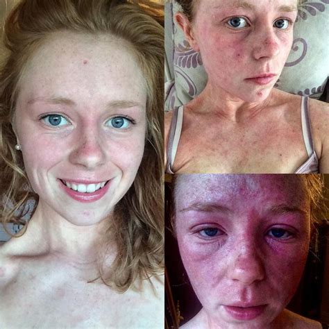 What Its Really Like Living With Eczema One Instagram Stars Path To