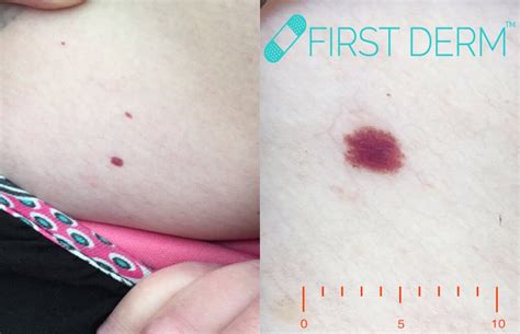 Tiny Red Blood Spots On Skin Little Red Spots On Skin Learn The