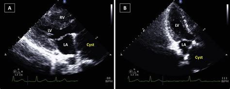 A Parasternal Long Axis View On Transthoracic Echocardiography Tte Download Scientific