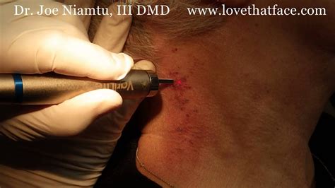 port wine stain birthmark laser removal by dr joe niamtu iii youtube
