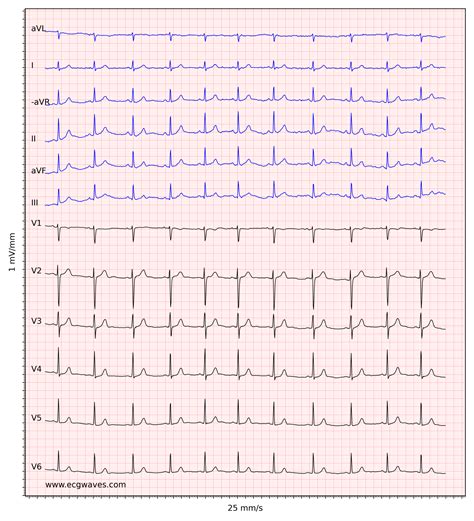 Electrocardiogram Ecg Shows Normal Sinus Rhythm With St Elevation In