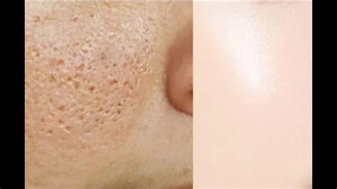 How To Minimise Pores How To Shrink Open Pores Permanently 100 Results Youtube