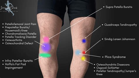 Knee Pain Location Chart Learn The Pain Location Of Knee Injuries