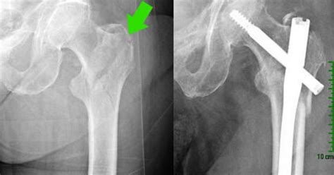 Osteoporosis Case Study 3 Hip Fracture Repair