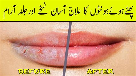 Easy Ways To Cure Chapped Lips In Minutes Dry Lips Treatment Youtube