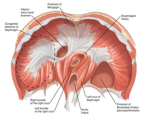 Laparoscopic Diaphragmatic Hernia Repair Primum Non Nocere Acute