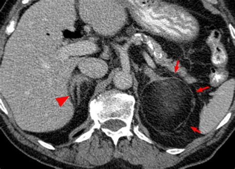 Imaging Of The Adrenal Gland Lesions