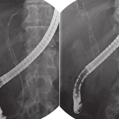 Y Shaped Self Expandable Metallic Stent Was Inserted At The Time Of