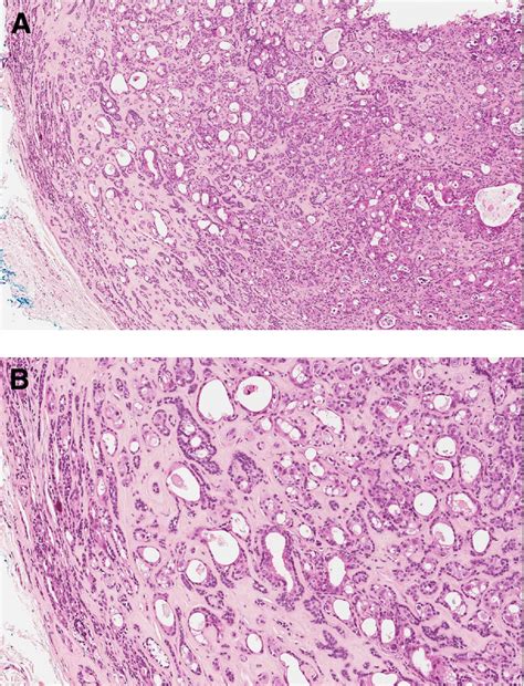 Carcinoma Ex Pleomorphic Adenoma In A Minor Salivary Gland Of The Upper