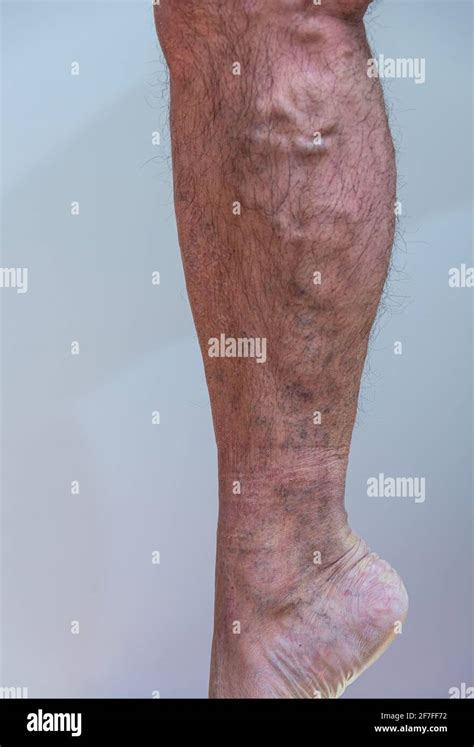 Varicose Vein High Resolution Stock Photography And Images Alamy