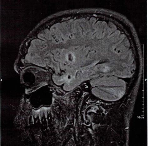 Case 3 Brain Mri Uae Pathology Flickr