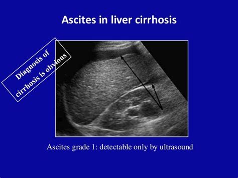 Modern medicine has no cure for liver cirrhosis and many die waiting on their. Cirrhosis Of The Liver Ultrasound Images - Goldenacresdogs.com