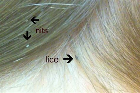 Head Lice And Nits In Children The Symptoms And Treatment