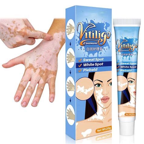 Buy Vitiligo Cream, Vitiligo , Vitiligo Care Cream, Vitiligo Cream for