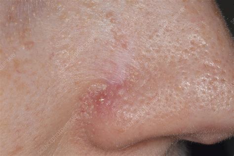 Basal Cell Carcinoma Scar Stock Image C0498740 Science Photo Library