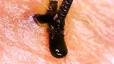 Some ignorant person said it happens to only dirty people, well i think thats really silly as ingrown hairs affects a large percentage of africans and leads to bumps even if you bathe ten times a day! Plucking Thick Black Hair (HD) - How To Pluck without ...