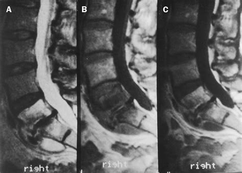 Mycobacterium Xenopi Spinal Infections After Discovertebral Surgery
