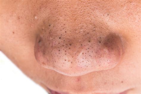 Under Your Skin The Inside Story On Blackheads Whiteheads