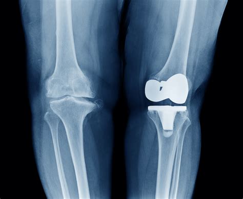 Osteoarthritis Knee Diagram