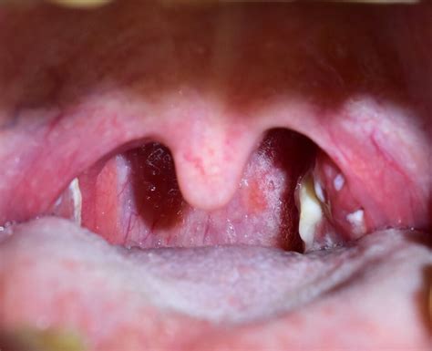 Tonsillite Streptococcica