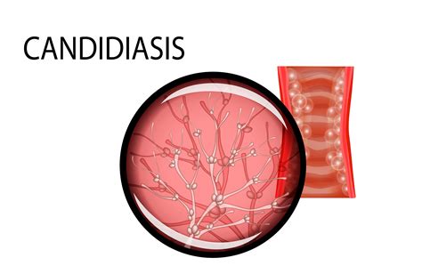 Early Signs And Symptoms Of Candidiasis Infection Health Works Collective