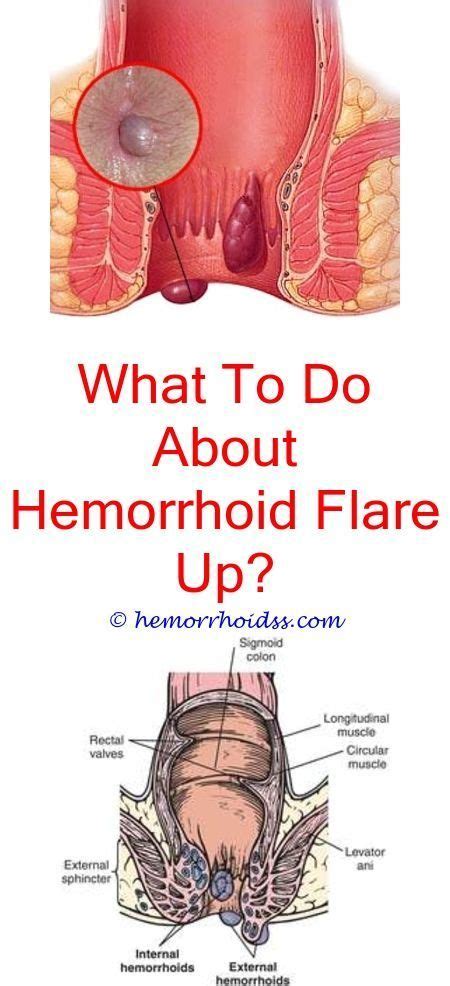 When You Need Surgery For Hemorrhoidshow Do They Remove A Hemorrhoid