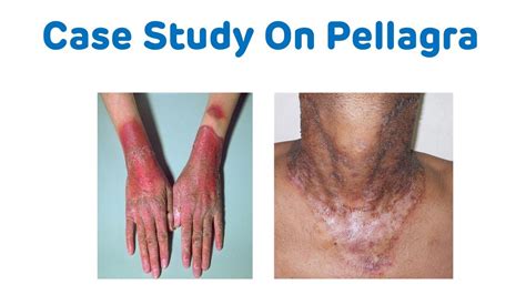Case Study On Pellagra Biochemistry Case Study Pellagra B3