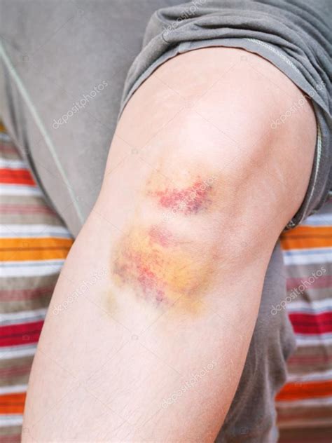 Knee Injury Bruise On Leg — Stock Photo © Vvoennyy 39046163