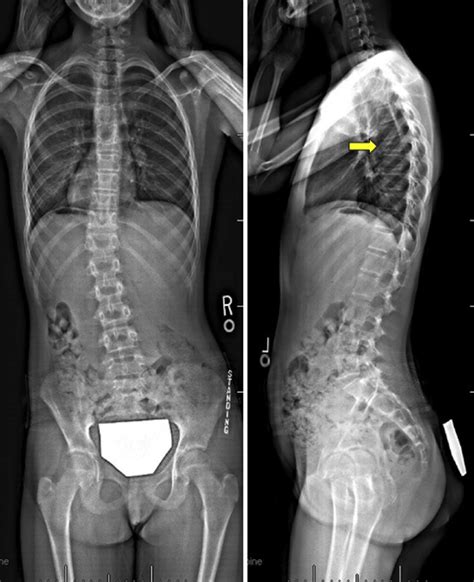Standing Spinal X Rays Shows A Compression Fracture Of T7 Vertebral