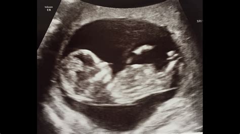 12 Weeks Scan Boy Or Girl I Cant See The Nub Netmums Chat