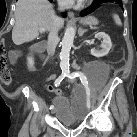 Lymphocele Post Groin Lymph Node Dissection For Melanoma Image