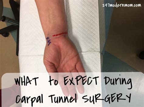 Carpal Tunnel Surgery What To Expect During The Procedure