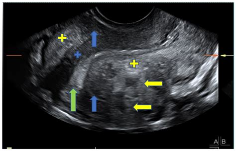 jcm free full text sonographic signs of adenomyosis in women with hot sex picture