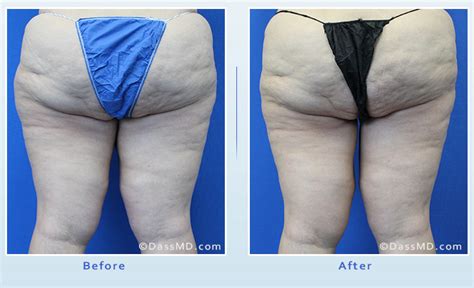 Medial Thigh Lift Before And After