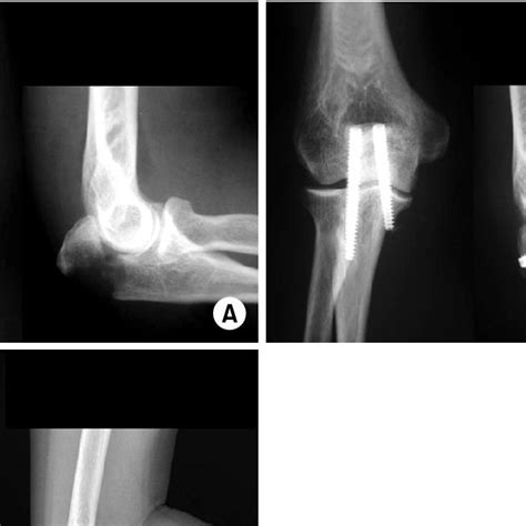 A Radiographs Show Olecranon Fracture Of Type Iia B These