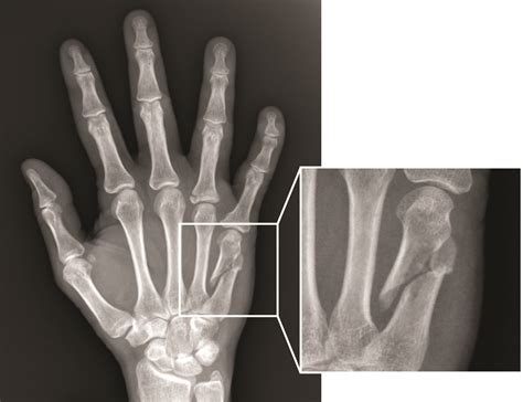 Hand Fracture Raleigh Hand Surgery Joseph J Schreiber Md