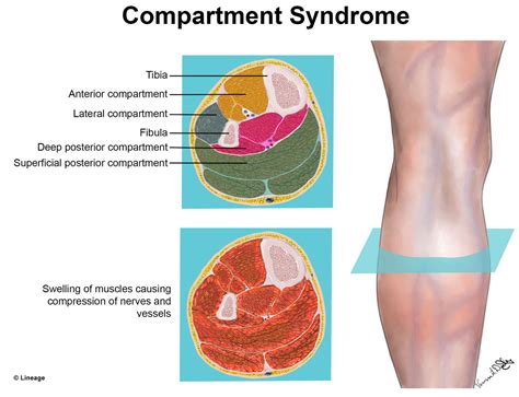 Compartment Syndrome Pictures