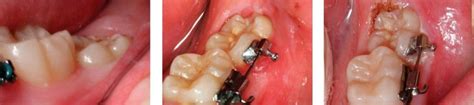 Gum Disease Laser Therapy Diamond Bar Ca