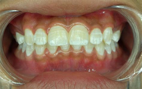 Have Post Orthodontic White Spots Heres How It Can Be Treated Santa