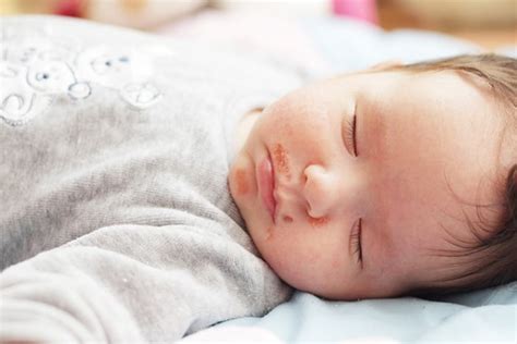 9 Penyakit Kulit Pada Bayi Paling Umum Dan Cara Mengatasinya
